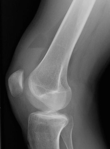 Knee Radiograph