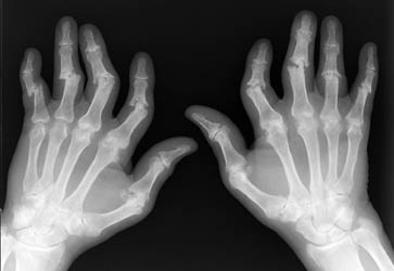 Psoriasis Distribution Pattern