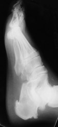 Ankylosing Spondylitis: Lateral- Broad base calcaneal spur and erosion of the calcaneus