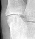 Osteoarthritis: Oblique view shows small osteophyte at 1st TMT joint