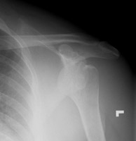 Coracoid Process Fracture