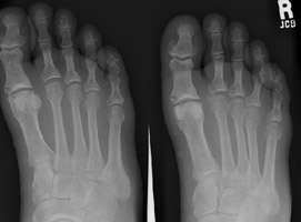 distal phalanges foot