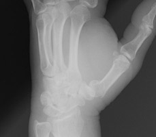 first metacarpal fracture splint