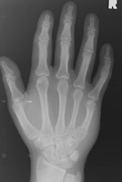 base of 1st metacarpal fracture