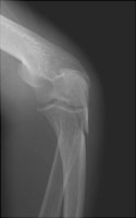 olecranon fracture orthobullets