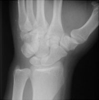 Fracture Hamate