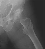 left hip intertrochanteric fracture icd 10