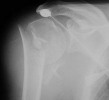 X Ray Image Demonstrating The New Fracture On The Left Humerus And Images