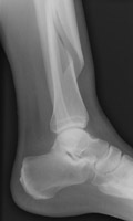 Spiral Fracture Tibia