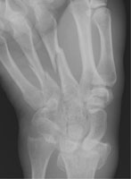 colles fracture right wrist icd 10