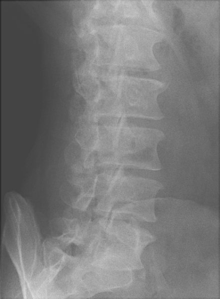 Listhesis at l5-s1